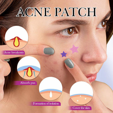 Sadoer Spot Acne Patches, 78 Pieces - Image 2